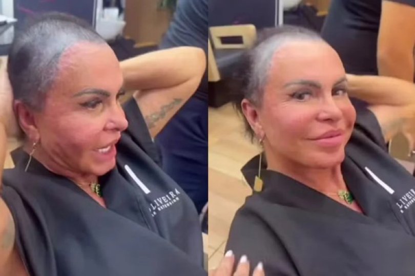 Gretchen diz que procedimento prejudicou cabelo e aumentou alopecia...