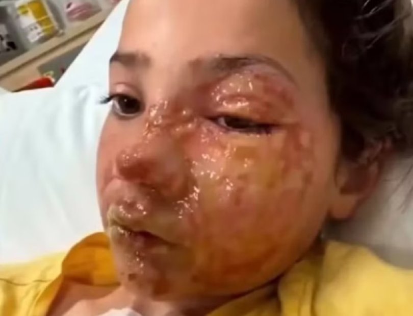 Menina de 10 anos sofre queimaduras após desafio viral...