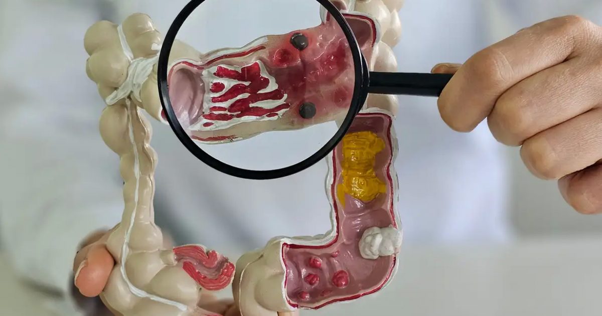 Em 13 anos, doença inflamatória intestinal cresce 5 vezes no Brasil