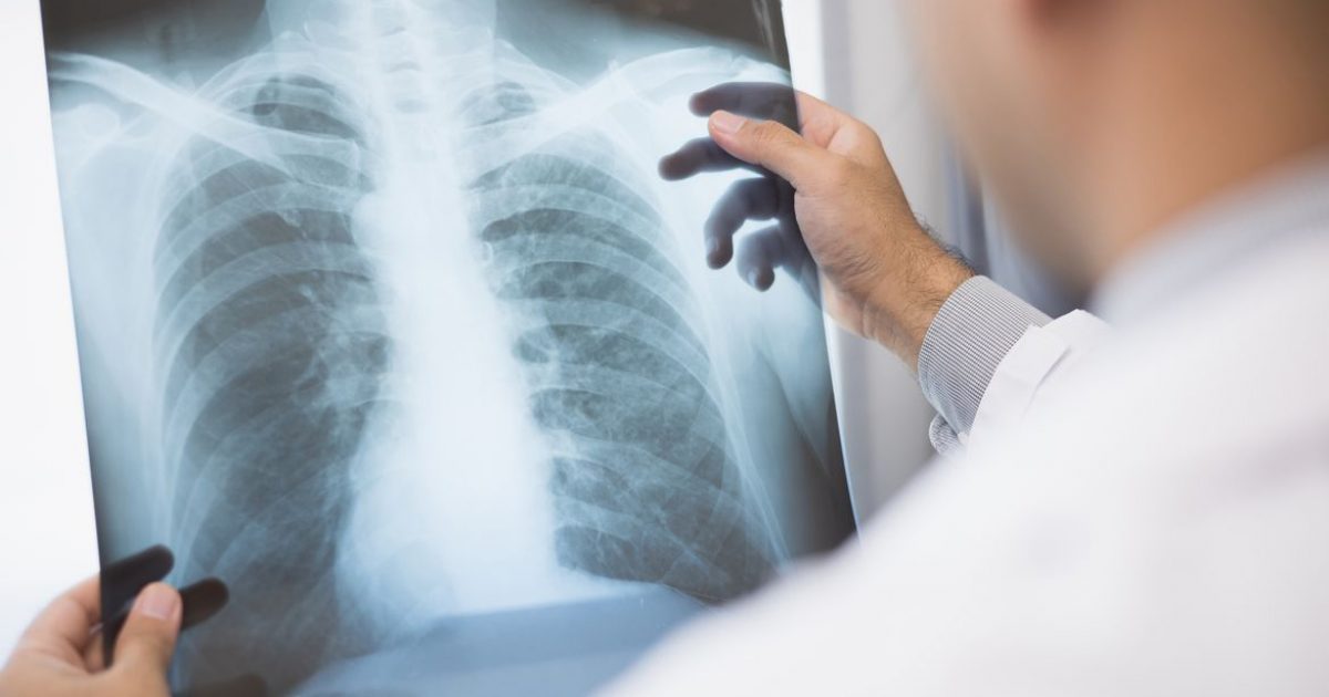 Anvisa aprova novo medicamento para câncer de pulmão avançado